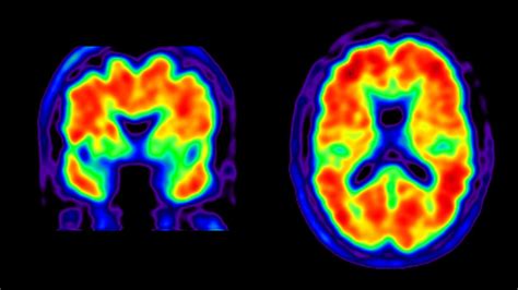 How Accurate is a PET Scan for Alzheimer's: Unraveling the Mysteries of the Mind and Beyond