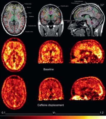 Why No Caffeine Before PET Scan: A Journey Through Time and Space